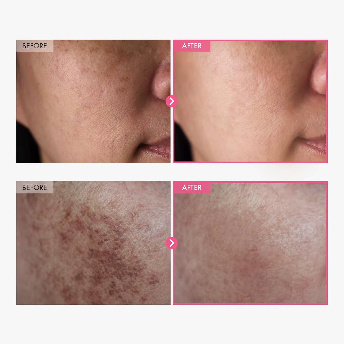 Crème Éclaircissante Tosowoong 50ml - 7% Arbutine, 4% Acide Tranexamique, Correcteur de Taches Sombres